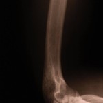 elbow pain Elbow Pain Treatment by Physiotherapy