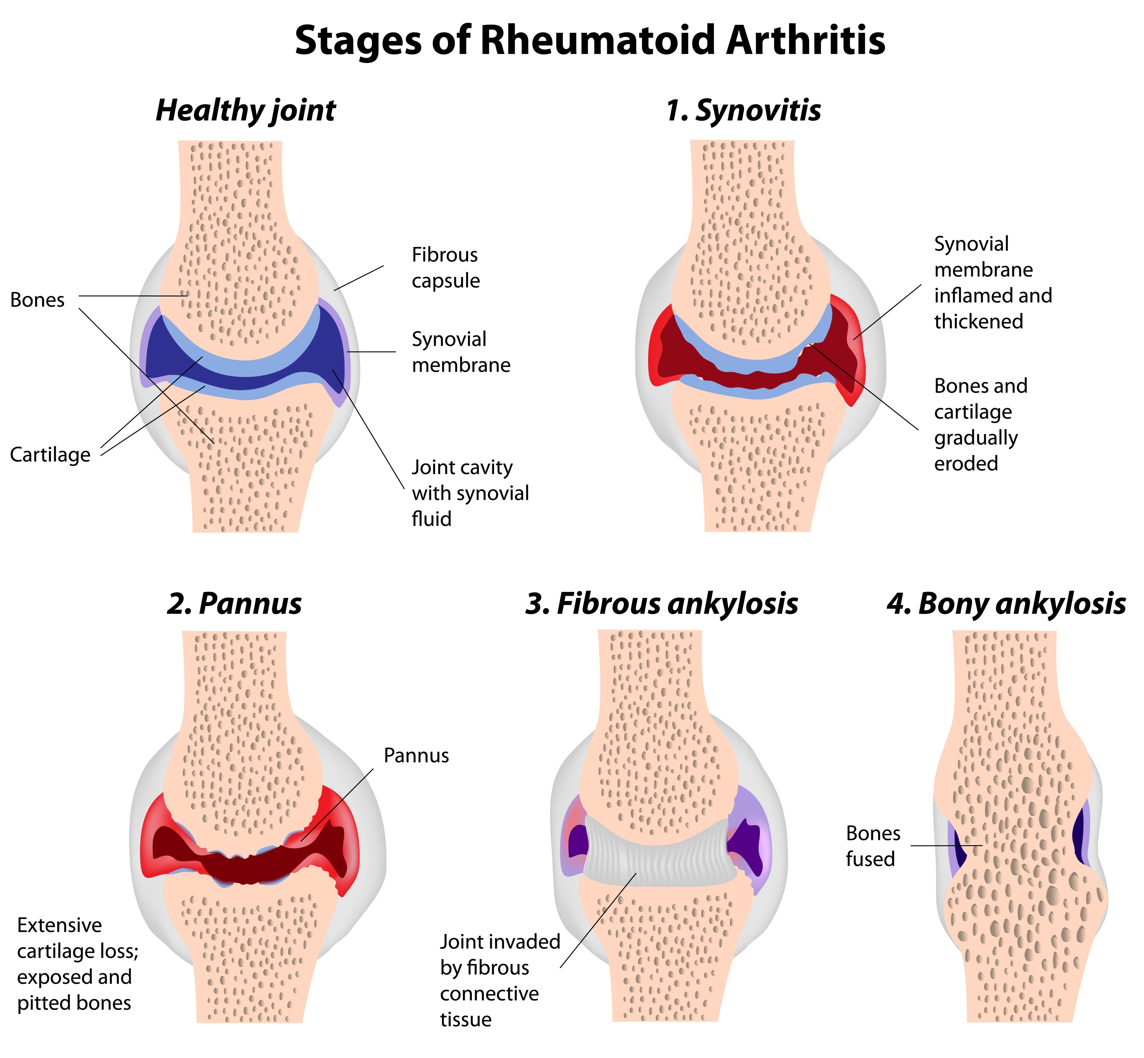 what-skin-problems-does-rheumatoid-arthritis-cause