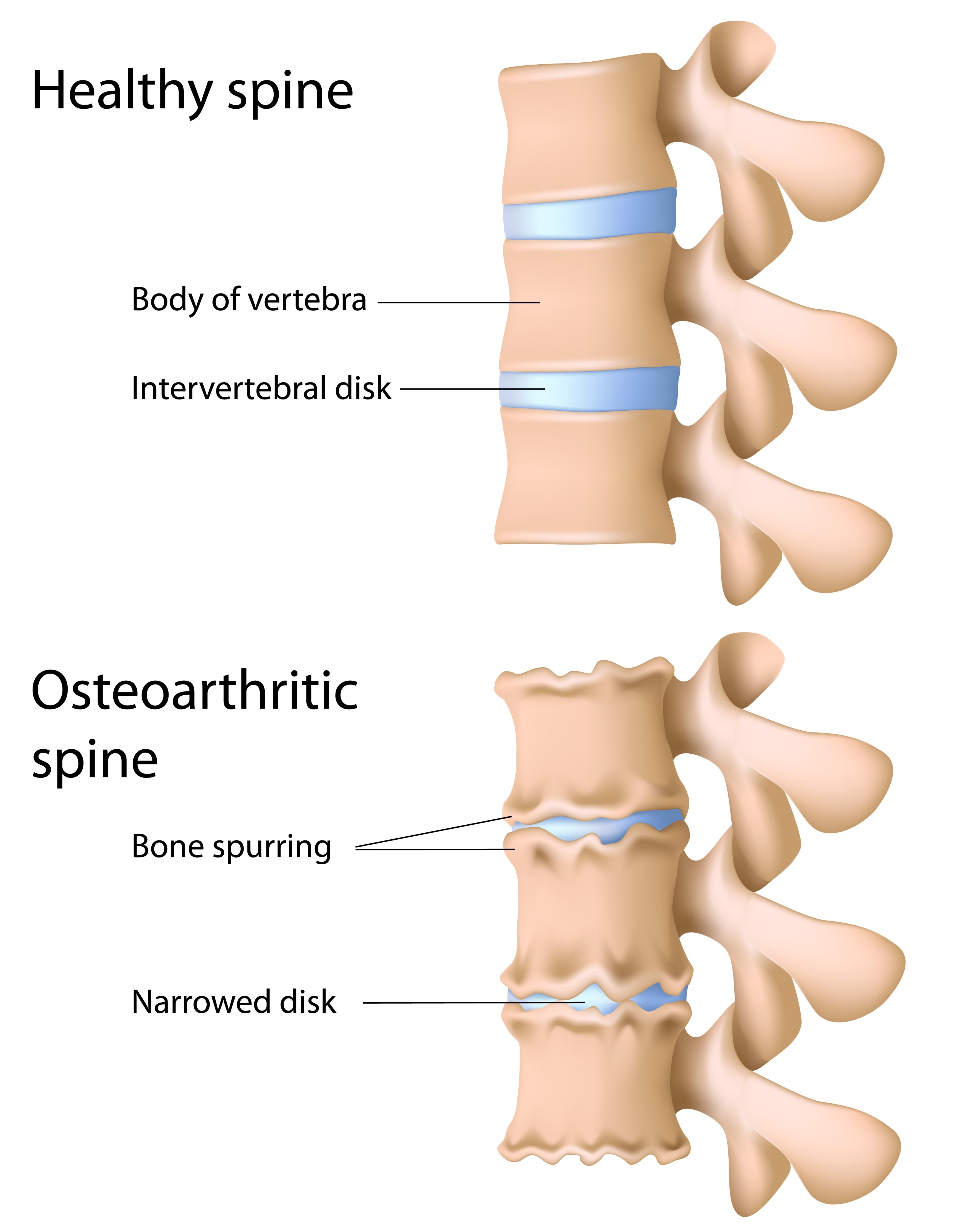 spondylosis-cervical-spondylosis-lumbarsacral-spondylosis