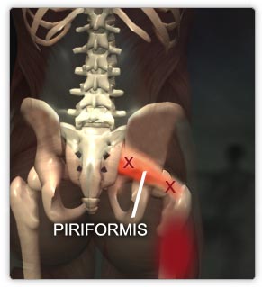 Physiotherapy for Piriformis Syndrome