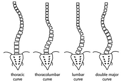 Scoliosis and Physiotherapy Treatment