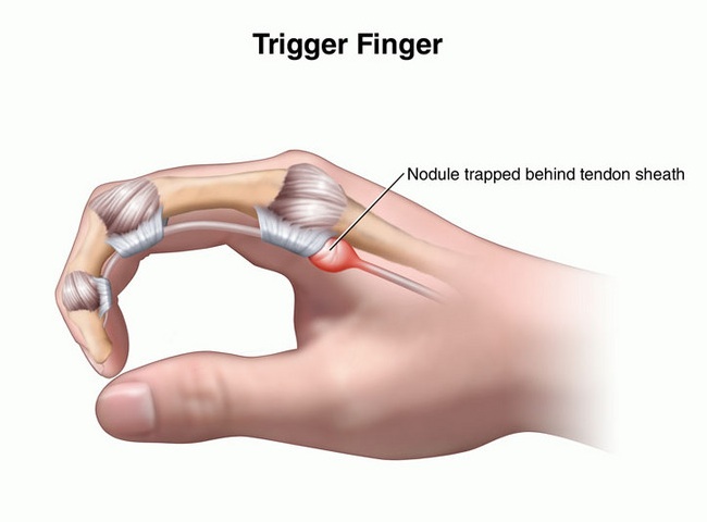 Physiotherapy for Trigger Finger