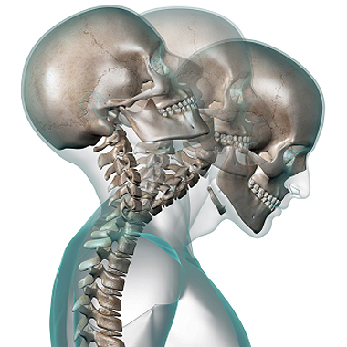 Physiotherapy for Whiplash Injury