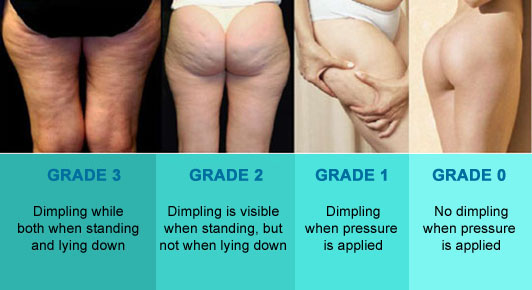 Stages Of Cellulite